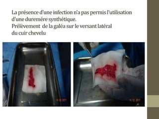 Laprésenced’uneinfectionn’apaspermisl’utilisation
d’unedureméresynthétique.
Prélèvement delagaléasurleversantlatéral
ducuirchevelu
 