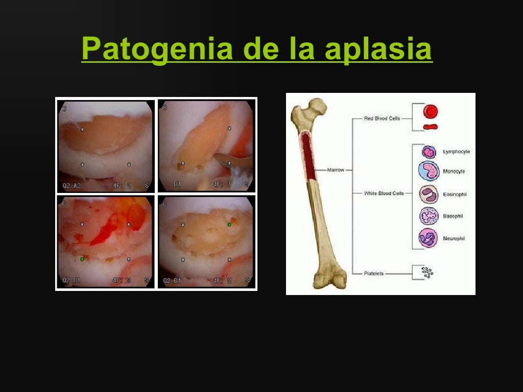 Aplasia Medular Pode Matar BRAINCP