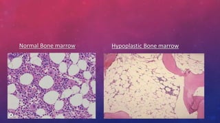 Normal Bone marrow Hypoplastic Bone marrow
 