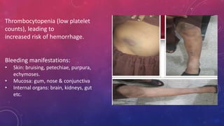 Thrombocytopenia (low platelet
counts), leading to
increased risk of hemorrhage.
Bleeding manifestations:
• Skin: bruising, petechiae, purpura,
echymoses.
• Mucosa: gum, nose & conjunctiva
• Internal organs: brain, kidneys, gut
etc.
 