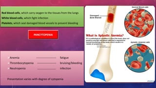 PANCYTOPENIA
Anemia --------------------- fatigue
Thrombocytopenia -------------------- bruising/bleeding
Neutropenia …………………….. infection
Presentation varies with degree of cytopenia
Red blood cells, which carry oxygen to the tissues from the lungs
White blood cells, which fight infection
Platelets, which seal damaged blood vessels to prevent bleeding
 