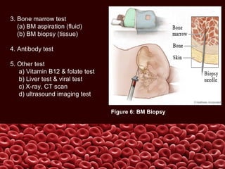 3. Bone marrow test
(a) BM aspiration (fluid)
(b) BM biopsy (tissue)
4. Antibody test
5. Other test
a) Vitamin B12 & folate test
b) Liver test & viral test
c) X-ray, CT scan
d) ultrasound imaging test
Figure 6: BM Biopsy
 