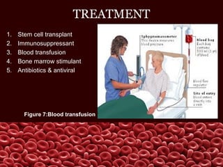 TREATMENT
1. Stem cell transplant
2. Immunosuppressant
3. Blood transfusion
4. Bone marrow stimulant
5. Antibiotics & antiviral
Figure 7:Blood transfusion
 