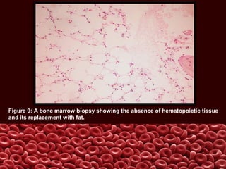 Figure 9: A bone marrow biopsy showing the absence of hematopoietic tissue
and its replacement with fat.
 