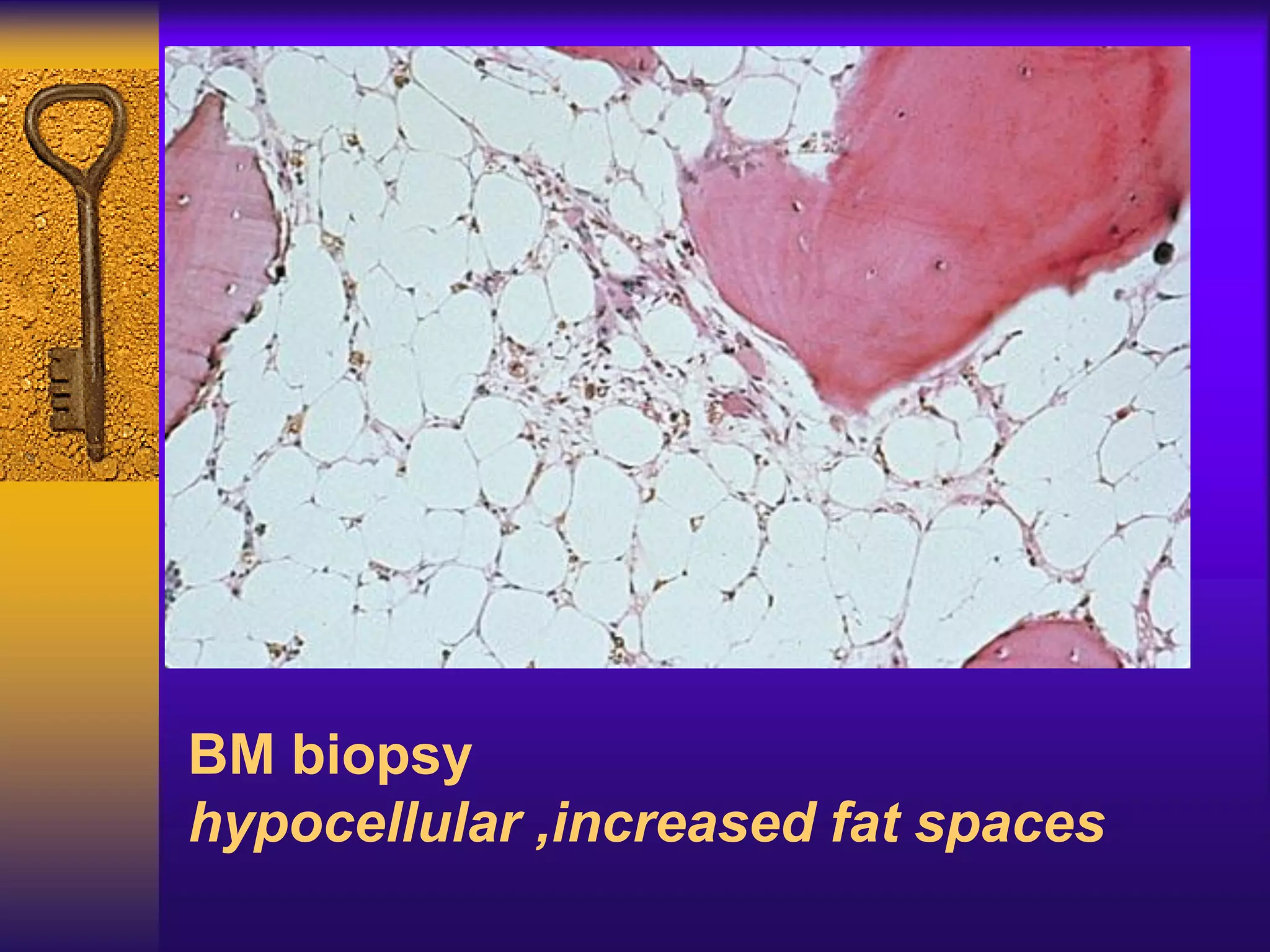 BM biopsy
hypocellular ,increased fat spaces
 