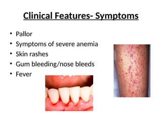 Clinical Features- Symptoms
• Pallor
• Symptoms of severe anemia
• Skin rashes
• Gum bleeding/nose bleeds
• Fever
 