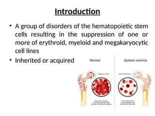 Introduction
• A group of disorders of the hematopoietic stem
cells resulting in the suppression of one or
more of erythroid, myeloid and megakaryocytic
cell lines
• Inherited or acquired
 
