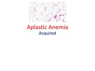 Aplastic Anemia
Acquired
 