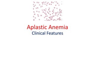 Aplastic Anemia
Clinical Features
 