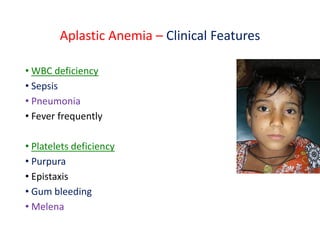 Aplastic Anemia – Clinical Features
• WBC deficiency
• Sepsis
• Pneumonia
• Fever frequently
• Platelets deficiency
• Purpura
• Epistaxis
• Gum bleeding
• Melena
 