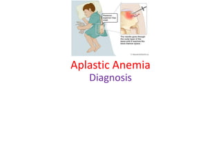 Aplastic Anemia
Diagnosis
 