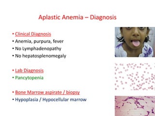 Aplastic Anemia – Diagnosis
• Clinical Diagnosis
• Anemia, purpura, fever
• No Lymphadenopathy
• No hepatosplenomegaly
• Lab Diagnosis
• Pancytopenia
• Bone Marrow aspirate / biopsy
• Hypoplasia / Hypocellular marrow
 