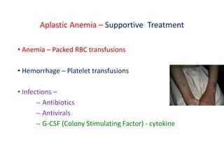 Aplastic Anemia – Supportive Treatment
• Anemia – Packed RBC transfusions
• Hemorrhage – Platelet transfusions
• Infections –
-- Antibiotics
-- Antivirals
-- G-CSF (Colony Stimulating Factor) - cytokine
 