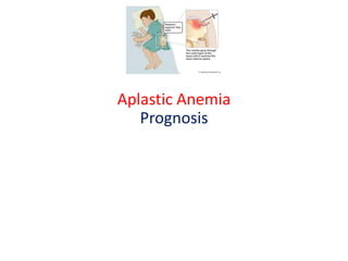 Aplastic Anemia
Prognosis
 