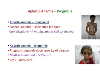 Aplastic Anemia – Prognosis
• Aplastic Anemia – Congenital
• Fanconi Anemia – shortened life span
Complications – AML, Squamous cell carcinoma
• Aplastic Anemia - Idiopathic
• Prognosis depends upon severity of disease
• Medical treatment – 50 % cure
• BMT – 80 % cure
 