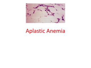 Aplastic Anemia
 