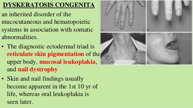Aplastic anemia pediatrics