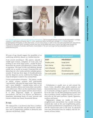 50 years of age should suggest the possibility of an
underlying metabolic disease or a familial disorder.
Acute synovitis (pseudogout) The patient, typically a
middle-aged woman, complains of acute pain and
swelling in one of the larger joints – usually the knee.
Sometimes the attack is precipitated by a minor illness
or operation. The joint is tense and inﬂamed, though
usually not as acutely as in gout. Untreated the con-
dition lasts for a few weeks and then subsides sponta-
neously. X-rays may show signs of chondrocalcinosis,
and the diagnosis can be conﬁrmed by ﬁnding posi-
tively birefringent crystals in the synovial ﬂuid.
Chronic pyrophosphate arthropathy The patient, usually
an elderly woman, presents with polyarticular
‘osteoarthritis’ affecting the larger joints (hips, knees)
and – more helpfully – unusual joints, such as the
ankles, shoulders, elbows and wrists where osteoarthri-
tis is seldom seen. There are the usual features of pain,
stiffness, swelling, joint crepitus and loss of movement.
It is often diagnosed, simply, as ‘generalized
osteoarthritis’, but the x-ray features are distinctive.
Sometimes alternating bouts of acute synovitis and
chronic arthritis may mimic rheumatoid disease.
X-rays
The characteristic x-ray features arise from a combina-
tion of (1) intra-articular and peri-articular calciﬁca-
tion, and (2) degenerative arthritis in distinctive sites
(Resnick and Resnick, 1983).
Calciﬁcation is usually seen in and around the
knees, wrists, shoulders, hips, pubic symphysis and
intervertebral discs; it is often bilateral and symmetri-
cal. In articular cartilage it appears as a thin line paral-
lel to the joint. In the ﬁbrocartilaginous menisci and
discs it produces cloudy, irregular opacities. Less com-
mon sites are the joint synovium, capsule, ligaments,
tendons and bursae.
Degenerative changes are similar to those of
straightforward osteoarthritis but notably involving
unusual sites such as the non-weightbearing joints,
the isolated patellofemoral compartment in the knee
and the talonavicular joint in the foot. In advanced
cases joint destruction may be marked, with the for-
mation of loose bodies.
Crystaldepositiondisorders
81
4
(a)
4.5 Chondrocalcinosis and pyrophosphate arthropathy Calcium pyrophosphate crystals may be deposited in cartilage,
causing (a) calciﬁcation of menisci and (b) a thin, dense line within the articular cartilage. (c,d) Chronic calcium
pyrophosphate arthropathy, on the other hand, is much more serious, as seen in this man who presented with osteoarthritis
in several of the larger joints, including unusual sites such as the elbow and ankle. X-ray of the right knee showed the
characteristic features of articular calciﬁcation, loose bodies in the joint and large trailing osteophytes around the
patellofemoral joint.
GOUT AND PSEUDOGOUT
GOUT PSEUDOGOUT
Smaller joints Large joints
Pain intense Pain moderate
Joint inﬂamed Joint swollen
Hyperuricaemia Chondrocalcinosis
Uric acid crystals Ca pyrophosphate crystals
(b) (c) (d)
 