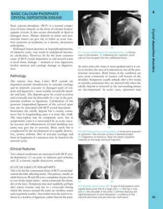 BASIC CALCIUM PHOSPHATE
CRYSTAL DEPOSITION DISEASE
Basic calcium phosphate (BCP) is a normal compo-
nent of bone mineral, in the form of calcium hydrox-
yapatite crystals. It also occurs abnormally in dead or
damaged tissue. Minute deposits in joints and peri-
articular tissues can give rise to either an acute reac-
tion (synovitis or tendinitis) or a chronic, destructive
arthropathy.
Prolonged hypercalcaemia or hyperphosphataemia,
of whatever cause, may result in widespread metasta-
tic calciﬁcation. However, by far the most common
cause of BCP crystal deposition in and around joints
is local tissue damage – strained or torn ligaments,
tendon attrition and cartilage damage or degenera-
tion.
Pathology
The minute (less than 1 mm) BCP crystals are
deposited around chondrocytes in articular cartilage
and in relatively avascular or damaged parts of ten-
dons and ligaments – most notably around the shoul-
der and knee. The deposits grow by crystal accretion
and eventually may be detectable by x-ray in the peri-
articular tendons or ligaments. Calciﬁcation of the
posterior longitudinal ligament of the cervical spine
may also be associated with BCP crystal deposition.
Sometimes the calciﬁc deposit has a creamy consis-
tency but in longstanding cases it is more like chalk.
The mini-tophus may be completely inert, but in
symptomatic cases it is surrounded by an acute vascu-
lar reaction and inﬂammation. Crystal shedding into
joints may give rise to synovitis. More rarely this is
complicated by the development of a rapidly destruc-
tive, erosive arthritis. Bits of articular cartilage and
bone or fragments of a meniscus may be found in the
synovial cavity.
Clinical features
Two clinical syndromes are associated with BCP crys-
tal deposition: (1) an acute or subacute peri-arthritis;
and (2) a chronic rapidly destructive arthritis.
ACUTE OR SUBACUTE PERI-ARTHRITIS
This is by far the commonest form of BCP crystal dep-
osition disorder affecting joints. The patient, usually an
adult between 30 and 50 years, complains of pain close
to one of the larger joints – most commonly the shoul-
der or the knee. Symptoms may start suddenly, perhaps
after minor trauma, and rise to a crescendo during
which the tissues around the joint are swollen, warm
and exquisitely tender – but tender near the joint in re-
lation to a tendon or ligament, rather than in the joint.
At other times the onset is more gradual and it is eas-
ier to localize the area of tenderness to one of the peri-
articular structures. Both forms of the condition are
seen most commonly in rotator cuff lesions of the
shoulder. Symptoms usually subside after a few weeks
or months; sometimes they are aborted only when the
calciﬁc deposit is removed or the surrounding tissues
are decompressed. In acute cases, operation may
Crystaldepositiondisorders
83
4
4.7 Acute calciﬁcation of supraspinatus (a) Dense
mass in the tendon. (b) Following the ‘reaction’ some
calcium has escaped into the subdeltoid bursa.
(a) (b)
4.9 Rapidly destructive OA X-rays of two patients with
rapidly destructive OA of a large joint, (a) the hip in one
and (b) the shoulder in the other. Common features are
rapid progression to joint disruption, crumbling of the
sub-articular bone and peri-articular ossiﬁcation.
(a) (b)
4.8 BCP destructive arthropathy (a) Knee joint exposed
at operation. The articular surface is severely eroded.
(b) Fragments of meniscus. Note the white crystalline
material on the large meniscal fragment.
(a) (b)
 