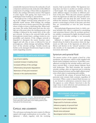 considerable interaction between the molecules of each
component and between the molecules of the different
components of cartilage: if these links are degraded or
broken, the cartilage will tend to unravel. This happens
to some degree with ageing, but much more so in
pathological states leading to osteoarthritis.
Proteoglycan has a strong afﬁnity for water, result-
ing in the collagen network being subjected to con-
siderable tensile stresses. With loading, the cartilage
deforms and water is slowly squeezed onto the surface
where it helps to form a lubricating ﬁlm. When load-
ing ceases, the surface ﬂuid seeps back into the carti-
lage up to the point where the swelling pressure in the
cartilage is balanced by the tensile force of the colla-
gen network. As long as the network holds and the
proteoglycans remain intact, cartilage retains its com-
pressibility and elasticity. If the collagen network is
degraded or disrupted, the matrix becomes water-
logged and soft; this, in turn, is followed by loss of
proteoglycans, cellular damage and splitting (‘ﬁbrilla-
tion’) of the articular cartilage. Trouble mounts up
further as the damaged chondrocytes begin to release
matrix-degrading enzymes.
CAPSULE AND LIGAMENTS
The soft tissues enclosing the joint consist of a ﬁbrous
capsule with tough condensations on its surface – the
ligaments – which, together with the overlying
muscles, help to provide stability. The ligaments run-
ning from one bone to another are inelastic and have
a ﬁxed length. Not surprisingly, therefore, they are
under different degrees of tension in different posi-
tions of the joint. When the joint assumes a position
where the ligaments are fully taut, they provide maxi-
mum stability and may keep the joint ‘locked’ even
without the assistance of muscles; when less taut they
permit a certain degree of laxity in the joint; and when
they are overstretched or torn the joint becomes
unstable.
Non-pathological ligamentous laxity is a fairly com-
mon heritable trait which is employed to astonishing
(and sometimes bizarre) effect by acrobatic perform-
ers; stability is maintained by highly developed muscle
power and the articular cartilage is not necessarily
damaged.
Inﬂamed or injured joints that need splinting
should always be held in the position where the liga-
ments are fully taut; if the ligaments are allowed to
ﬁbrose and shorten in the ‘relaxed’ position it may
take months (or be impossible) to regain full passive
movement afterwards.
Synovium and synovial fluid
The interior surface of the capsule is lined by a thin
membrane, the synovium, which is richly supplied with
blood vessels, lymphatics and nerves. It provides a non-
adherent covering for the articular surfaces and it pro-
duces synovial ﬂuid, a viscous plasma dialysate laced
with hyaluronan. This ﬂuid nourishes the avascular
articular cartilage, plays an important part in reducing
friction during movement and has slight adhesive prop-
erties which assist in maintaining joint stability.
In normal life the volume of synovial ﬂuid in any
particular joint remains fairly constant, regardless of
movement. When a joint is injured ﬂuid increases (as
in any bruised or oedematous connective tissue) and
this appears as a joint effusion. Synovium is also the
target tissue in joint infections and autoimmune dis-
orders such as rheumatoid arthritis.
GENERALORTHOPAEDICS
86
5
THREATS TO CARTILAGE INTEGRITY
Loss of joint stability
Localized increase in loading stress
Increased stiffness of the cartilage
Inﬂammatory (enzymatic) degradation
Restriction of free joint movement
Sclerosis in the subchondral bone
5.2 Normal articular cartilage Normal articular cartilage,
smooth and glistening, is well preserved into old age.
These specimens were taken from elderly patients with
fractures of the femoral neck.
MECHANISMS FOR MAINTAINING
JOINT STABILITY
Alignment of joint components
Shape and ﬁt of articular surfaces
Adhesive property of synovial ﬂuid
Integrity of capsule and ligaments
Muscle tone and power
Neurological control of balance
 