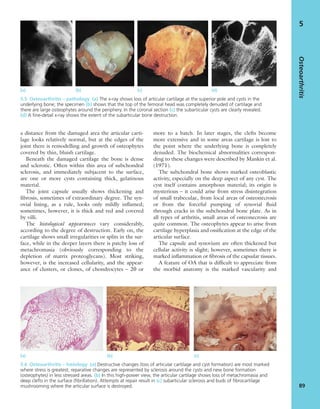 a distance from the damaged area the articular carti-
lage looks relatively normal, but at the edges of the
joint there is remodelling and growth of osteophytes
covered by thin, bluish cartilage.
Beneath the damaged cartilage the bone is dense
and sclerotic. Often within this area of subchondral
sclerosis, and immediately subjacent to the surface,
are one or more cysts containing thick, gelatinous
material.
The joint capsule usually shows thickening and
ﬁbrosis, sometimes of extraordinary degree. The syn-
ovial lining, as a rule, looks only mildly inﬂamed;
sometimes, however, it is thick and red and covered
by villi.
The histological appearances vary considerably,
according to the degree of destruction. Early on, the
cartilage shows small irregularities or splits in the sur-
face, while in the deeper layers there is patchy loss of
metachromasia (obviously corresponding to the
depletion of matrix proteoglycans). Most striking,
however, is the increased cellularity, and the appear-
ance of clusters, or clones, of chondrocytes – 20 or
more to a batch. In later stages, the clefts become
more extensive and in some areas cartilage is lost to
the point where the underlying bone is completely
denuded. The biochemical abnormalities correspon-
ding to these changes were described by Mankin et al.
(1971).
The subchondral bone shows marked osteoblastic
activity, especially on the deep aspect of any cyst. The
cyst itself contains amorphous material; its origin is
mysterious – it could arise from stress disintegration
of small trabeculae, from local areas of osteonecrosis
or from the forceful pumping of synovial ﬂuid
through cracks in the subchondral bone plate. As in
all types of arthritis, small areas of osteonecrosis are
quite common. The osteophytes appear to arise from
cartilage hyperplasia and ossiﬁcation at the edge of the
articular surface.
The capsule and synovium are often thickened but
cellular activity is slight; however, sometimes there is
marked inﬂammation or ﬁbrosis of the capsular tissues.
A feature of OA that is difﬁcult to appreciate from
the morbid anatomy is the marked vascularity and
Osteoarthritis
89
5
(a) (b) (c) (d)
5.5 Osteoarthritis – pathology (a) The x-ray shows loss of articular cartilage at the superior pole and cysts in the
underlying bone; the specimen (b) shows that the top of the femoral head was completely denuded of cartilage and
there are large osteophytes around the periphery. In the coronal section (c) the subarticular cysts are clearly revealed.
(d) A ﬁne-detail x-ray shows the extent of the subarticular bone destruction.
(a) (b) (c)
5.6 Osteoarthritis – histology (a) Destructive changes (loss of articular cartilage and cyst formation) are most marked
where stress is greatest; reparative changes are represented by sclerosis around the cysts and new bone formation
(osteophytes) in less stressed areas. (b) In this high-power view, the articular cartilage shows loss of metachromasia and
deep clefts in the surface (ﬁbrillation). Attempts at repair result in (c) subarticular sclerosis and buds of ﬁbrocartilage
mushrooming where the articular surface is destroyed.
 