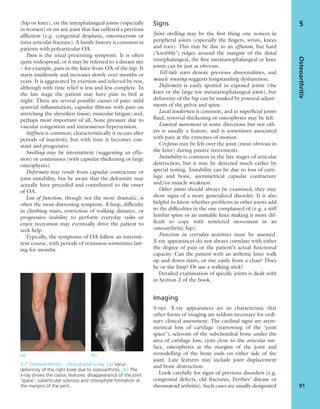 (hip or knee), on the interphalangeal joints (especially
in women) or on any joint that has suffered a previous
afﬂiction (e.g. congenital dysplasia, osteonecrosis or
intra-articular fracture). A family history is common in
patients with polyarticular OA.
Pain is the usual presenting symptom. It is often
quite widespread, or it may be referred to a distant site
– for example, pain in the knee from OA of the hip. It
starts insidiously and increases slowly over months or
years. It is aggravated by exertion and relieved by rest,
although with time relief is less and less complete. In
the late stage the patient may have pain in bed at
night. There are several possible causes of pain: mild
synovial inﬂammation, capsular ﬁbrosis with pain on
stretching the shrunken tissue; muscular fatigue; and,
perhaps most important of all, bone pressure due to
vascular congestion and intraosseous hypertension.
Stiffness is common; characteristically it occurs after
periods of inactivity, but with time it becomes con-
stant and progressive.
Swelling may be intermittent (suggesting an effu-
sion) or continuous (with capsular thickening or large
osteophytes).
Deformity may result from capsular contracture or
joint instability, but be aware that the deformity may
actually have preceded and contributed to the onset
of OA.
Loss of function, though not the most dramatic, is
often the most distressing symptom. A limp, difﬁculty
in climbing stairs, restriction of walking distance, or
progressive inability to perform everyday tasks or
enjoy recreation may eventually drive the patient to
seek help.
Typically, the symptoms of OA follow an intermit-
tent course, with periods of remission sometimes last-
ing for months.
Signs
Joint swelling may be the ﬁrst thing one notices in
peripheral joints (especially the ﬁngers, wrists, knees
and toes). This may be due to an effusion, but hard
(‘knobbly’) ridges around the margins of the distal
interphalangeal, the ﬁrst metatarsophalangeal or knee
joints can be just as obvious.
Tell-tale scars denote previous abnormalities, and
muscle wasting suggests longstanding dysfunction.
Deformity is easily spotted in exposed joints (the
knee or the large-toe metatarsophalangeal joint), but
deformity of the hip can be masked by postural adjust-
ments of the pelvis and spine.
Local tenderness is common, and in superﬁcial joints
ﬂuid, synovial thickening or osteophytes may be felt.
Limited movement in some directions but not oth-
ers is usually a feature, and is sometimes associated
with pain at the extremes of motion.
Crepitus may be felt over the joint (most obvious in
the knee) during passive movements.
Instability is common in the late stages of articular
destruction, but it may be detected much earlier by
special testing. Instability can be due to loss of carti-
lage and bone, asymmetrical capsular contracture
and/or muscle weakness.
Other joints should always be examined; they may
show signs of a more generalized disorder. It is also
helpful to know whether problems in other joints add
to the difﬁculties in the one complained of (e.g. a stiff
lumbar spine or an unstable knee making it more dif-
ﬁcult to cope with restricted movement in an
osteoarthritic hip).
Function in everyday activities must be assessed.
X-ray appearances do not always correlate with either
the degree of pain or the patient’s actual functional
capacity. Can the patient with an arthritic knee walk
up and down stairs, or rise easily from a chair? Does
he or she limp? Or use a walking stick?
Detailed examination of speciﬁc joints is dealt with
in Section 2 of the book.
Imaging
X-rays X-ray appearances are so characteristic that
other forms of imaging are seldom necessary for ordi-
nary clinical assessment. The cardinal signs are asym-
metrical loss of cartilage (narrowing of the ‘joint
space’), sclerosis of the subchondral bone under the
area of cartilage loss, cysts close to the articular sur-
face, osteophytes at the margins of the joint and
remodelling of the bone ends on either side of the
joint. Late features may include joint displacement
and bone destruction.
Look carefully for signs of previous disorders (e.g.
congenital defects, old fractures, Perthes’ disease or
rheumatoid arthritis). Such cases are usually designated
Osteoarthritis
91
5
(a) (b)
5.7 Osteoarthritis – clinical and x-ray (a) Varus
deformity of the right knee due to osteoarthritis. (b) The
x-ray shows the classic features: disappearance of the joint
‘space’, subarticular sclerosis and osteophyte formation at
the margins of the joint.
 