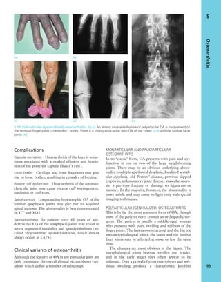 (a) (b)
(c) (d) (e)
5.10 Polyarticular (generalized) osteoarthritis (a,b) An almost invariable feature of polyarticular OA is involvement of
the terminal ﬁnger joints – Heberden’s nodes. There is a strong association with OA of the knees (c,d) and the lumbar facet
joints (e).
Complications
Capsular herniation Osteoarthritis of the knee is some-
times associated with a marked effusion and hernia-
tion of the posterior capsule (Baker’s cyst).
Loose bodies Cartilage and bone fragments may give
rise to loose bodies, resulting in episodes of locking.
Rotator cuff dysfunction Osteoarthritis of the acromio-
clavicular joint may cause rotator cuff impingement,
tendinitis or cuff tears.
Spinal stenosis Longstanding hypertrophic OA of the
lumbar apophyseal joints may give rise to acquired
spinal stenosis. The abnormality is best demonstrated
by CT and MRI.
Spondylolisthesis In patients over 60 years of age,
destructive OA of the apophyseal joints may result in
severe segmental instability and spondylolisthesis (so-
called ‘degenerative’ spondylolisthesis, which almost
always occurs at L4/5).
Clinical variants of osteoarthritis
Although the features of OA in any particular joint are
fairly consistent, the overall clinical picture shows vari-
ations which deﬁne a number of subgroups.
MONARTICULAR AND PAUCIARTICULAR
OSTEOARTHRITIS
In its ‘classic’ form, OA presents with pain and dys-
function in one or two of the large weightbearing
joints. There may be an obvious underlying abnor-
mality: multiple epiphyseal dysplasia, localized acetab-
ular dysplasia, old Perthes’ disease, previous slipped
epiphysis, inﬂammatory joint disease, avascular necro-
sis, a previous fracture or damage to ligaments or
menisci. In the majority, however, the abnormality is
more subtle and may come to light only with special
imaging techniques.
POLYARTICULAR (GENERALIZED) OSTEOARTHRITIS
This is by far the most common form of OA, though
most of the patients never consult an orthopaedic sur-
geon. The patient is usually a middle-aged woman
who presents with pain, swelling and stiffness of the
ﬁnger joints. The ﬁrst carpometacarpal and the big toe
metatarsophalangeal joints, the knees and the lumbar
facet joints may be affected at more or less the same
time.
The changes are most obvious in the hands. The
interphalangeal joints become swollen and tender,
and in the early stages they often appear to be
inﬂamed. Over a period of years osteophytes and soft-
tissue swelling produce a characteristic knobbly
Osteoarthritis
93
5
 