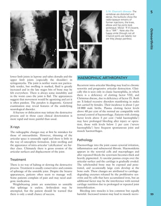 lower limb joints in leprosy and tabes dorsalis and the
upper limb joints (especially the shoulder) in
syringomyelia. The joint is neither warm nor particu-
larly tender, but swelling is marked, ﬂuid is greatly
increased and in the late stages bits of bone may be
felt everywhere. There is always some instability and
in the worst cases the joint is ﬂail. The appearances
suggest that movement would be agonizing and yet it
is often painless. The paradox is diagnostic. General
examination may reveal features of the underlying
neurological disorder.
A fracture or dislocation may initiate the destructive
process and in those cases clinical deterioration is
more rapid and more painful than usual.
X-rays
The radiogaphic changes may at ﬁrst be mistaken for
those of osteoarthritis. However, thinning of the
articular space is unusually rapid and there is little in
the way of osteophyte formation. Joint swelling and
the appearance of intra-articular ‘calciﬁcation’ are fur-
ther clues. Ultimately there is gross erosion of the
articular surfaces and displacement of the joint.
Treatment
There is no way of halting or slowing the destructive
process. Treatment is usually conservative and consists
of splintage of the unstable joint. Despite the bizarre
appearances, patients often seem to manage well.
Some patients complain of pain and may need anal-
gesic medication.
Weightbearing joints are sometimes so unstable
that splintage is useless. Arthrodesis may be
attempted, but the patient should be warned that
there is only a small chance of success.
HAEMOPHILIC ARTHROPATHY
Recurrent intra-articular bleeding may lead to chronic
synovitis and progressive articular destruction. Clini-
cally this is seen only in classic haemophilia, in which
there is a deﬁciency of clotting factor VIII, and
Christmas disease, due to deﬁciency of factor IX. Both
are X-linked recessive disorders manifesting in males
but carried by females. Their incidence is about 1 per
10 000 male births. Plasma clotting factor levels
above 40 per cent of the normal are compatible with
normal control of haemorrhage. Patients with clotting
factor levels above 5 per cent (‘mild haemophilia’)
may have prolonged bleeding after injury or opera-
tion; those with levels below 1 per cent (‘severe
haemophilia’) have frequent spontaneous joint and
muscle haemorrhages.
Pathology
Haemorrhage into the joint causes synovial irritation,
inﬂammation and subsynovial ﬁbrosis. Haemosiderin
appears in the synovial cells and macrophages and
after repeated bleeds the synovium becomes thick and
heavily pigmented. A vascular pannus creeps over the
articular surface and the cartilage is gradually eroded.
The subchondral bone may be exposed and pene-
trated, and occasionally large cysts develop at the
bone ends. These changes are attributed to cartilage-
degrading enzymes released by the proliferative syn-
ovitis and by cells that have accumulated iron, but an
additional factor may be the interference with normal
cartilage nutrition due to prolonged or repeated joint
immobilization.
Bleeding into muscles is less common but equally
harmful. Increased tension may lead to muscle necro-
Osteoarthritis
99
55.16 Charcot’s disease The
vertebrae are distorted and
dense, the buttocks show the
radio-opaque remains of
former injections; the knee,
elbow and hip joints look
grotesque. Moral: ‘If it’s bizarre,
do a “WR”’. Note also the
happy smile (though not all
Charcot joints are tabetic nor
are they always painless).
 