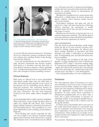 sis, reactive ﬁbrosis and joint contractures. Sometimes
nerves are compressed, causing a neurapraxia; tempo-
rary weakness may contribute further to the develop-
ment of joint deformity.
Cysts and pseudotumours are rare phenomena. A
large soft-tissue haematoma may become encapsu-
lated before it is absorbed, and may then draw in
more ﬂuid by osmosis to produce a slowly expanding
‘cyst’. A subperiosteal haematoma occasionally stimu-
lates cystic resorption of bone resembling a tumour.
Clinical features
Only males are affected and in severe haemophilia
joint bleeds usually begin when the child starts to
walk. The clinical picture depends on the severity of
the disorder, the site of bleeding and the efﬁcacy of
long-term treatment. The commonest features are
acute bleeding into joints or muscles, chronic arthritis
and joint contractures. The sites most frequently
involved are the knees, ankles, elbow, shoulders and
hips.
ACUTE BLEEDING INTO A JOINT, MUSCLE OR NERVE
With trivial injury a joint (usually the knee, elbow or
ankle) may rapidly ﬁll with blood. Pain, warmth,
boggy swelling, tenderness and limited movement are
the outstanding features. The resemblance to a low-
grade inﬂammatory joint is striking, but the history is
diagnostic.
Acute bleeding into muscles (especially the fore-
arm, calf or thigh) is less common. A painful swelling
appears and movement of the related joint is resisted.
The distinction from a haemarthosis may be difﬁcult
(e.g. with groin pain due to iliopsoas haemorrhage);
usually only those movements that stretch the affected
muscles are painful, whereas in haemarthrosis all
movements are painful.
Bleeding into a peripheral nerve causes intense pain
followed by a variable degree of sensory change and
muscle weakness. Nerve function usually recovers
after several months.
Neurological symptoms and signs may also be
caused by a large soft-tissue haematoma. Following
effective treatment, the haematoma is usually
resorbed within 10–14 days but full movement may
take longer to return.
Bleeding into the forearm or leg may give rise to a
classical compartment syndrome. The tell-tale signs of
acute pain and tissue tension should be heeded before
sensory and motor impairment are obvious.
JOINT DEGENERATION
This, the sequel to repeated bleeding, usually begins
before the age of 15 years. Chronic synovitis is fol-
lowed by cartilage degeneration. An affected joint
shows wasting, limitation of movement and ﬁxed
deformity not unlike a tuberculous or rheumatoid
joint. In longstanding cases, articular destruction may
lead to instability.
X-ray changes vary according to the stage of the
disorder. A useful classiﬁcation is that of Arnold and
Hilgartner (1977): Stage I – soft-tissue swelling; Stage
II – osteoporosis and epiphyseal overgrowth; Stage III
– slight narrowing of the articular space and squaring
of the bone ends; Stage IV – marked narrowing of the
articular space; and Stage V – joint disintegration.
Cysts and pseudotumours are rare complications.
Treatment
The most important aspect of treatment is to coun-
teract bleeding as soon as it occurs, or better still to
prevent recurrent bleeds. Patients are taught to rec-
ognize the early symptoms of bleeding and to admin-
ister the appropriate clotting factor concentrate
themselves. In some centres factor concentrate is
administered prophylactically two or three times a
week; this is given intravenously, if necessary by
indwelling catheter. It is essential to establish the pre-
cise diagnosis: factor VIII or IX is effective only for
the speciﬁc disorder.
In former years (and probably still in some parts of
the world) fresh-frozen plasma or concentrates that
had not undergone viral inactivation were used for
factor replacement, but this carried the risk of HIV
contamination. These products are no longer recom-
mended and have been replaced by virally inactivated
factor concentrates.
The acute bleed Bleeding into the tissues is treated by
GENERALORTHOPAEDICS
100
5
(a) (b)
5.17 Haemophilic arthropathy – clinical features
(a) Recurrent haemarthrosis and chronic synovitis led to
contractures of the elbow joints and deformities of the
knees and ankles. (b) This man had difﬁculty staying
upright, let alone walking, without support.
 