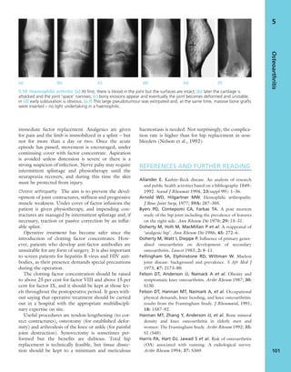 immediate factor replacement. Analgesics are given
for pain and the limb is immobilized in a splint – but
not for more than a day or two. Once the acute
episode has passed, movement is encouraged, under
continuing cover with factor concentrate. Aspiration
is avoided unless distension is severe or there is a
strong suspicion of infection. Nerve palsy may require
intermittent splintage and physiotherapy until the
neurapraxia recovers, and during this time the skin
must be protected from injury.
Chronic arthropathy The aim is to prevent the devel-
opment of joint contractures, stiffness and progressive
muscle weakness. Under cover of factor infusions the
patient is given physiotherapy, and impending con-
tractures are managed by intermittent splintage and, if
necessary, traction or passive correction by an inﬂat-
able splint.
Operative treatment has become safer since the
introduction of clotting factor concentrates. How-
ever, patients who develop anti-factor antibodies are
unsuitable for any form of surgery. It is also important
to screen patients for hepatitis B virus and HIV anti-
bodies, as their presence demands special precautions
during the operation.
The clotting factor concentration should be raised
to above 25 per cent for factor VIII and above 15 per
cent for factor IX, and it should be kept at those lev-
els throughout the postoperative period. It goes with-
out saying that operative treatment should be carried
out in a hospital with the appropriate multidiscipli-
nary expertise on site.
Useful procedures are tendon lengthening (to cor-
rect contractures), osteotomy (for established defor-
mity) and arthrodesis of the knee or ankle (for painful
joint destruction). Synovectomy is sometimes per-
formed but the beneﬁts are dubious. Total hip
replacement is technically feasible, but tissue dissec-
tion should be kept to a minimum and meticulous
haemostasis is needed. Not surprisingly, the complica-
tion rate is higher than for hip replacement in non-
bleeders (Nelson et al., 1992).
REFERENCES AND FURTHER READING
Allander E. Kashin–Beck disease. An analysis of research
and public health activities based on a bibliography 1849–
1992. Scand J Rheumat 1994; 23(suppl 99): 1–36.
Arnold WD, Hilgartner MW. Hemophilic arthropathy.
J Bone Joint Surg, 1977; 59A: 287–305.
Byers PD, Contepomi CA, Farkas TA. A post mortem
study of the hip joint including the prevalence of features
on the right side. Ann Rheum Dis 1970; 29: 15–31.
Doherty M, Holt M, MacMillan P et al. A reappraisal of
‘analgesic hip’. Ann Rheum Dis 1986; 45: 272–6.
Doherty M, Watt I, Dieppe P. Inﬂuence of primary gener-
alised osteoarthritis on development of secondary
osteoarthritis. Lancet 1983; 2: 8–11.
Fellingham SA, Elphinstone RD, Wittman W. Mseleni
joint disease: background and prevalence. S Afr Med J
1973; 47: 2173–80.
Felson DT, Anderson JJ, Namack A et al. Obesity and
symptomatic knee osteoarthritis. Arthr Rheum 1987; 30:
S130.
Felson DT, Hannan MT, Naimark A, et al. Occupational
physical demands, knee bending, and knee osteoarthritis:
results from the Framingham Study. J Rheumatol, 1991;
18: 1587–92.
Hannan MT, Zhang Y, Anderson JJ, et al. Bone mineral
density and knee osteoarthritis in elderly men and
women: The Framingham Study. Arthr Rheum 1992; 35:
S1 (S40).
Harris PA, Hart DJ, Jawad S et al. Risk of osteoarthritis
(OA) associated with running: A radiological survey.
Arthr Rheum 1994; 37: S369.
Osteoarthritis
101
5
(a) (b) (c) (d) (e) (f)
5.18 Haemophilic arthritis (a) At ﬁrst, there is blood in the joint but the surfaces are intact; (b) later the cartilage is
attacked and the joint ‘space’ narrows; (c) bony erosions appear and eventually the joint becomes deformed and unstable;
in (d) early subluxation is obvious. (e,f) This large pseudotumour was extirpated and, at the same time, massive bone grafts
were inserted – no light undertaking in a haemophilic.
 