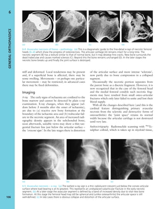 stiff and deformed. Local tenderness may be present
and, if a superﬁcial bone is affected, there may be
some swelling. Movements – or perhaps one particu-
lar movement – may be restricted; in advanced cases
there may be ﬁxed deformities.
Imaging
X-ray The early signs of ischaemia are conﬁned to the
bone marrow and cannot be detected by plain x-ray
examination. X-ray changes, when they appear (sel-
dom before 3 months after the onset of ischaemia),
are due to (a) reactive new bone formation at the
boundary of the ischaemic area and (b) trabecular fail-
ure in the necrotic segment. An area of increased radi-
ographic density appears in the subchondral bone;
soon afterwards, suitable views may show a thin tan-
gential fracture line just below the articular surface –
the ‘crescent sign’. In the late stages there is distortion
of the articular surface and more intense ‘sclerosis’,
now partly due to bone compression in a collapsed
segment.
Occasionally the necrotic portion separates from
the parent bone as a discrete fragment. However, it is
now recognized that in the case of the femoral head
and the medial femoral condyle such necrotic frag-
ments may have resulted from small osteo-articular
fractures which only later failed to unite and lost their
blood supply.
With all the changes described here (and this is the
cardinal feature distinguishing primary avascular
necrosis from the sclerotic and destructive forms of
osteoarthritis) the ‘joint space’ retains its normal
width because the articular cartilage is not destroyed
until very late.
Radioscintigraphy Radionuclide scanning with 99m
Tc-
sulphur colloid, which is taken up in myeloid tissue,
GENERALORTHOPAEDICS
106
6
(a) (b) (c) (d)
6.4 Avascular necrosis of bone – pathology (a) This is a diagramatic guide to the ﬁne-detail x-rays of necrotic femoral
heads (b–d) which show the progress of osteonecrosis. The articular cartilage (A) remains intact for a long time. The
necrotic segment (B) has a texture similar to that of normal bone, but it may develop ﬁne cracks. New bone surrounds the
dead trabeculae and causes marked sclerosis (C). Beyond this the bone remains unchanged (D). In the later stages the
necrotic bone breaks up and ﬁnally the joint surface is destroyed.
(a) (b) (c)
6.5 Avascular necrosis – x-ray (a) The earliest x-ray sign is a thin radiolucent crescent just below the convex articular
surface where load bearing is at its greatest. This represents an undisplaced subarticular fracture in the early necrotic
segment. (b) At a later stage the avascular segment is deﬁned by a band of increased density due to vital new bone
formation. At this stage the femoral head may still be spherical and (unlike osteoarthritis) the articular space is still
well-deﬁned. (c) In late cases there is obvious collapse and distortion of the articular surface.
 
