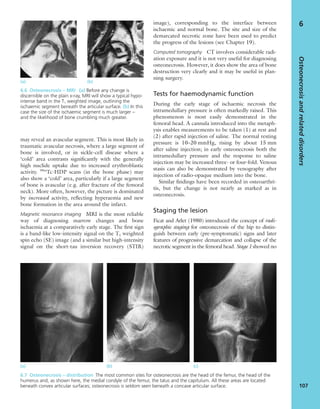 may reveal an avascular segment. This is most likely in
traumatic avascular necrosis, where a large segment of
bone is involved, or in sickle-cell disease where a
‘cold’ area contrasts signiﬁcantly with the generally
high nuclide uptake due to increased erythroblastic
activity. 99m
Tc-HDP scans (in the bone phase) may
also show a ‘cold’ area, particularly if a large segment
of bone is avascular (e.g. after fracture of the femoral
neck). More often, however, the picture is dominated
by increased activity, reﬂecting hyperaemia and new
bone formation in the area around the infarct.
Magnetic resonance imaging MRI is the most reliable
way of diagnosing marrow changes and bone
ischaemia at a comparatively early stage. The ﬁrst sign
is a band-like low-intensity signal on the T1 weighted
spin echo (SE) image (and a similar but high-intensity
signal on the short-tau inversion recovery (STIR)
image), corresponding to the interface between
ischaemic and normal bone. The site and size of the
demarcated necrotic zone have been used to predict
the progress of the lesions (see Chapter 19).
Computed tomography CT involves considerable radi-
ation exposure and it is not very useful for diagnosing
osteonecrosis. However, it does show the area of bone
destruction very clearly and it may be useful in plan-
ning surgery.
Tests for haemodynamic function
During the early stage of ischaemic necrosis the
intramedullary pressure is often markedly raised. This
phenomenon is most easily demonstrated in the
femoral head. A cannula introduced into the metaph-
ysis enables measurements to be taken (1) at rest and
(2) after rapid injection of saline. The normal resting
pressure is 10–20 mmHg, rising by about 15 mm
after saline injection; in early osteonecrosis both the
intramedullary pressure and the response to saline
injection may be increased three- or four-fold. Venous
stasis can also be demonstrated by venography after
injection of radio-opaque medium into the bone.
Similar ﬁndings have been recorded in osteoarthri-
tis, but the change is not nearly as marked as in
osteonecrosis.
Staging the lesion
Ficat and Arlet (1980) introduced the concept of radi-
ographic staging for osteonecrosis of the hip to distin-
guish between early (pre-symptomatic) signs and later
features of progressive demarcation and collapse of the
necrotic segment in the femoral head. Stage 1 showed no
Osteonecrosisandrelateddisorders
107
6
(a) (b) (c)
(a) (b)
6.6 Osteonecrosis – MRI (a) Before any change is
discernible on the plain x-ray, MRI will show a typical hypo-
intense band in the T1 weighted image, outlining the
ischaemic segment beneath the articular surface. (b) In this
case the size of the ischaemic segment is much larger –
and the likelihood of bone crumbling much greater.
6.7 Osteonecrosis – distribution The most common sites for osteonecrosis are the head of the femur, the head of the
humerus and, as shown here, the medial condyle of the femur, the talus and the capitulum. All these areas are located
beneath convex articular surfaces; osteonecrosis is seldom seen beneath a concave articular surface.
 