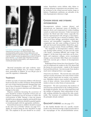 Bacterial osteomyelitis and septic arthritis, some-
times involving multiple sites, are serious complica-
tions, particularly in children. In over 50 per cent of
cases the organism is Salmonella.
Treatment
A follow-up study of untreated children with femoral
head necrosis due to sickle-cell disease showed that 80
per cent of them had permanently damaged hips with
severe loss of function (Hernigou et al., 1991). This
may be due to recurrent infarction and inﬂammatory
changes in the joint.
Hypoxic conditions favouring the occurrence of
crises should be avoided. If episodes of bone pain are
frequent, transfusions may be necessary to reduce the
concentration of HbS. During a crisis the patient
should be given adequate analgesia and should be kept
fully oxygenated. Infections should be guarded against,
or treated promptly with the appropriate antibiotics.
Femoral head necrosis in children should be treated
in the same way as Perthes’ disease (see page 511).
Adults are treated along the lines described on page
531. The emphasis in all cases should be on conser-
vatism. Anaesthesia carries deﬁnite risks; failure to
maintain adequate oxygenation may precipitate vascu-
lar occlusion in the central nervous system, lungs or
kidneys. Prophylactic antibiotics are advisable as the
risk of postoperative infection is high.
CAISSON DISEASE AND DYSBARIC
OSTEONECROSIS
Decompression sickness (caisson disease) and
osteonecrosis are important causes of disability in
deep-sea divers and compressed-air workers building
tunnels or underwater structures. Under increased air
pressure the blood and other tissues (especially fat)
become supersaturated with nitrogen; if decompres-
sion is too rapid the gas is released as bubbles, which
cause local tissue damage, generalized embolic phe-
nomena and intracapillary coagulation. Prolonged
compression may also cause swelling of marrow fat
cells and decreased intramedullary blood ﬂow, possi-
bly due to oxygen toxicity (Pooley and Walder, 1984).
The symptoms of decompression sickness, which
may develop within minutes, are pain near the joints
(‘the bends’), breathing difﬁculty and vertigo (‘the
staggers’). In the most acute cases there can be circu-
latory and respiratory collapse, severe neurological
changes, coma and death. Only 10 per cent of patients
with bone necrosis give a history of decompression
sickness.
Radiological bone lesions have been found in 17 per
cent of compressed-air workers in the UK; almost half
the lesions are juxta-articular – mainly in the humeral
head and femoral head – but microscopic bone death is
much more widespread than x-rays suggest.
Clinical and x-ray features The necrosis may cause pain
and loss of joint movement, but many lesions remain
‘silent’ and are found only on routine x-ray examina-
tion. Medullary infarcts cause mottled calciﬁcation or
areas of dense sclerosis. Juxta-articular changes are
similar to those in other forms of osteonecrosis.
Management The aim is prevention; the incidence of
osteonecrosis is proportional to the working pressure,
the length of exposure, the rate of decompression and
the number of exposures. Strict enforcement of suit-
able working schedules has reduced the risks consid-
erably. The treatment of established lesions follows
the principles already outlined.
GAUCHER’S DISEASE (see also page 177)
In this familial disorder lack of a speciﬁc enzyme
results in the abnormal storage of glucocerebroside in
the macrophages of the reticuloendothelial system.
Osteonecrosisandrelateddisorders
111
6
6.9 Sickle-cell disease (a) Typical features of
osteonecrosis are seen in the femoral head, often
accompanied by patchy areas of bone destruction and
endosteal sclerosis in the femoral shaft. (b) The spine also
may be involved, producing appearances similar to those of
bone infection. (c) In severe cases infarctions of tubular
bones may resemble osteomyelitis, with sequestra and a
marked periosteal reaction.
(a)
(b) (c)
 