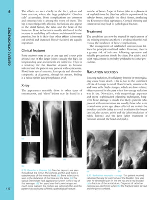 The effects are seen chieﬂy in the liver, spleen and
bone marrow, where the large polyhedral ‘Gaucher
cells’ accumulate. Bone complications are common
and osteonecrosis is among the worst of them. The
hip is most frequently affected, but lesions also appear
in the distal femur, the talus and the head of the
humerus. Bone ischaemia is usually attributed to the
increase in medullary cell volume and sinusoidal com-
pression, but it is likely that other effects (abnormal
cell emboli and increased blood viscosity) are equally
important.
Clinical features
Bone necrosis may occur at any age and causes pain
around one of the larger joints (usually the hip). In
longstanding cases movements are restricted. There is
a tendency for the Gaucher deposits to become
infected and the patient may present with septicaemia.
Blood tests reveal anaemia, leucopenia and thrombo-
cytopaenia. A diagnostic, though inconstant, ﬁnding
is a raised serum acid phosphatase level.
X-ray
The appearances resemble those in other types of
osteonecrosis, and ‘silent’ lesions may be found in a
number of bones. A special feature (due to replacement
of myeloid tissue by Gaucher cells) is expansion of the
tubular bones, especially the distal femur, producing
the Erlenmeyer ﬂask appearance. Cortical thinning and
osteoporosis may lead to pathological fracture.
Treatment
The condition can now be treated by replacement of
the missing enzyme and there is evidence that this will
reduce the incidence of bone complications.
The management of established osteonecrosis fol-
lows the principles outlined earlier. However, there is
a greater risk of infection following operation and
suitable precautions should be taken. For adults, total
joint replacement is probably preferable to other pro-
cedures.
RADIATION NECROSIS
Ionizing radiation, if sufﬁciently intense or prolonged,
may cause bone death. This is due to the combined
effects of damage to small blood vessels, marrow cells
and bone cells. Such changes, which are dose-related,
often occurred in the past when low-energy radiation
was in use. Nowadays, with megavoltage apparatus
and more sophisticated planning techniques, long-
term bone damage is much less likely; patients who
present with osteonecrosis are usually those who were
treated some years ago. Areas affected are mainly the
shoulder and ribs (after external irradiation for breast
cancer), the sacrum, pelvis and hip (after irradiation of
pelvic lesions) and the jaws (after treatment of
tumours around the head and neck).
GENERALORTHOPAEDICS
112
6
(a)
(b)
(c) (d)
6.10 Gaucher’s disease (a) Gaucher deposits are seen
throughout the femur. The cortices are thin and there is
osteonecrosis of the femoral head. (b) Bone infarction is
seen in the distal end of the tibia and the talus. (c) The
typical Erlenmeyer ﬂask appearance is seen in the x-ray of
this teenager. (d) Ten years later the bone changes are
much more marked, the cortices are extremely thin and the
patient has obviously suffered a pathological fracture.
6.11 Radiation necrosis – x-rays This patient received
radiation therapy for carcinoma of the bladder. One year
later he developed pain in the left hip and x-ray showed
(a) a fracture of the acetabulum. Diagnosis of radiation
necrosis was conﬁrmed when (b) the fracture failed to heal
and the joint crumbled.
(a) (b)
 