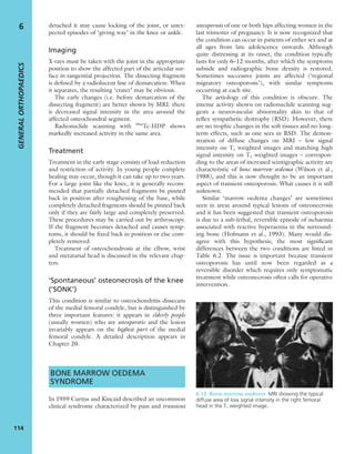 detached it may cause locking of the joint, or unex-
pected episodes of ‘giving way’ in the knee or ankle.
Imaging
X-rays must be taken with the joint in the appropriate
position to show the affected part of the articular sur-
face in tangential projection. The dissecting fragment
is deﬁned by a radiolucent line of demarcation. When
it separates, the resulting ‘crater’ may be obvious.
The early changes (i.e. before demarcation of the
dissecting fragment) are better shown by MRI: there
is decreased signal intensity in the area around the
affected osteochondral segment.
Radionuclide scanning with 99m
Tc-HDP shows
markedly increased activity in the same area.
Treatment
Treatment in the early stage consists of load reduction
and restriction of activity. In young people complete
healing may occur, though it can take up to two years.
For a large joint like the knee, it is generally recom-
mended that partially detached fragments be pinned
back in position after roughening of the base, while
completely detached fragments should be pinned back
only if they are fairly large and completely preserved.
These procedures may be carried out by arthroscopy.
If the fragment becomes detached and causes symp-
toms, it should be ﬁxed back in position or else com-
pletely removed.
Treatment of osteochondrosis at the elbow, wrist
and metatarsal head is discussed in the relevant chap-
ters.
‘Spontaneous’ osteonecrosis of the knee
(‘SONK’)
This condition is similar to osteochondritis dissecans
of the medial femoral condyle, but is distinguished by
three important features: it appears in elderly people
(usually women) who are osteoporotic and the lesion
invariably appears on the highest part of the medial
femoral condyle. A detailed description appears in
Chapter 20.
BONE MARROW OEDEMA
SYNDROME
In 1959 Curtiss and Kincaid described an uncommon
clinical syndrome characterized by pain and transient
osteoporosis of one or both hips affecting women in the
last trimester of pregnancy. It is now recognized that
the condition can occur in patients of either sex and at
all ages from late adolescence onwards. Although
quite distressing at its onset, the condition typically
lasts for only 6–12 months, after which the symptoms
subside and radiographic bone density is restored.
Sometimes successive joints are affected (‘regional
migratory osteoporosis’), with similar symptoms
occurring at each site.
The aetiology of this condition is obscure. The
intense activity shown on radionuclide scanning sug-
gests a neurovascular abnormality akin to that of
reﬂex sympathetic dystrophy (RSD). However, there
are no trophic changes in the soft tissues and no long-
term effects, such as one sees in RSD. The demon-
stration of diffuse changes on MRI – low signal
intensity on T1 weighted images and matching high
signal intensity on T2 weighted images – correspon-
ding to the areas of increased scintigraphic activity are
characteristic of bone marrow oedema (Wilson et al.,
1988), and this is now thought to be an important
aspect of transient osteoporosis. What causes it is still
unknown.
Similar ‘marrow oedema changes’ are sometimes
seen in areas around typical lesions of osteonecrosis
and it has been suggested that transient osteoporosis
is due to a sub-lethal, reversible episode of ischaemia
associated with reactive hyperaemia in the surround-
ing bone (Hofmann et al., 1993). Many would dis-
agree with this hypothesis; the most signiﬁcant
differences between the two conditions are listed in
Table 6.2. The issue is important because transient
osteoporosis has until now been regarded as a
reversible disorder which requires only symptomatic
treatment while osteonecrosis often calls for operative
intervention.
GENERALORTHOPAEDICS
114
6
6.13 Bone marrow oedema MRI showing the typical
diffuse area of low signal intensity in the right femoral
head in the T1 weighted image.
 
