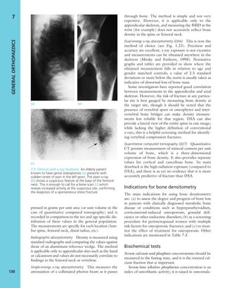 pressed in grams per unit area (or unit volume in the
case of quantitative computed tomography) and is
recorded in comparison to the sex and age speciﬁc dis-
tribution of these values in the general population.
The measurements are speciﬁc for each location (lum-
bar spine, femoral neck, distal radius, etc).
Radiographic absorptiometry Density is measured using
standard radiographs and comparing the values against
those of an aluminium reference wedge. The method
is applicable only to appendicular sites such as the hand
or calcaneum and values do not necessarily correlate to
ﬁndings in the femoral neck or vertebrae.
Single-energy x-ray absorptiometry This measures the
attenuation of a collimated photon beam as it passes
through bone. The method is simple and not very
expensive. However, it is applicable only to the
appendicular skeleton, and measuring the BMD at the
wrist (for example) does not accurately reﬂect bone
density in the spine or femoral neck.
Dual-energy x-ray absorptiometry (DXA) This is now the
method of choice (see Fig. 1.23). Precision and
accuracy are excellent, x-ray exposure is not excessive
and measurements can be obtained anywhere in the
skeleton (Mirsky and Einhorn, 1998). Normative
graphs and tables are provided to show where the
obtained measurement falls in relation to age and
gender matched controls; a value of 2.5 standard
deviations or more below the norm is usually taken as
indicative of abnormal loss of bone mass.
Some investigators have reported good correlation
between measurements in the appendicular and axial
skeleton. However, the risk of fracture at any particu-
lar site is best gauged by measuring bone density at
the target site, though it should be noted that the
presence of vertebral spurs or osteophytes and inter-
vertebral bone bridges can make density measure-
ments less reliable for that region. DXA can also
provide a lateral view of the entire spine in one image;
while lacking the higher deﬁnition of conventional
x-rays, this is a helpful screening method for identify-
ing vertebral compression fractures.
Quantitative computed tomography (QCT) Quantitative
CT permits measurement of mineral content per unit
volume of bone, which is a three-dimensional
expression of bone density. It also provides separate
values for cortical and cancellous bone. Its main
drawback is the high radiation exposure (compared to
DXA), and there is as yet no evidence that it is more
accurately predictive of fracture than DXA.
Indications for bone densitometry
The main indications for using bone densitometry
are: (a) to assess the degree and progress of bone loss
in patients with clinically diagnosed metabolic bone
disease or conditions such as hyperparathyroidism,
corticosteroid-induced osteoporosis, gonadal deﬁ-
ciency or other endocrine disorders; (b) as a screening
procedure for perimenopausal women with multiple
risk factors for osteoporotic fractures; and (c) to mon-
itor the effect of treatment for osteoporosis. Other
indications are mentioned in Table 7.3.
Biochemical tests
Serum calcium and phosphate concentrations should be
measured in the fasting state, and it is the ionized cal-
cium fraction that is important.
Serum bone alkaline phosphatase concentration is an
index of osteoblastic activity; it is raised in osteomala-
GENERALORTHOPAEDICS
130
7
(a) (b)
(c)
7.9 Clinical and x-ray features An elderly patient
known to have spinal osteoporosis (a) presents with
sudden onset of pain in the left groin. The plain x-ray
(b) shows a suspicious feature at the base of the femoral
neck. This is enough to call for a bone scan (c) which
reveals increased activity at the suspicious site, conﬁrming
the diagnosis of a spontaneous stress fracture.
 