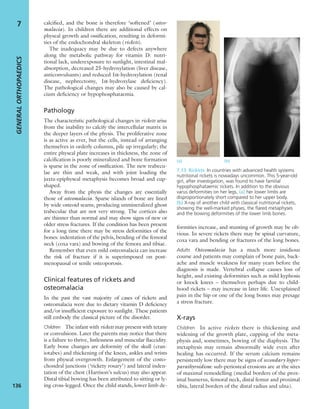 calciﬁed, and the bone is therefore ‘softened’ (osteo-
malacia). In children there are additional effects on
physeal growth and ossiﬁcation, resulting in deformi-
ties of the endochondral skeleton (rickets).
The inadequacy may be due to defects anywhere
along the metabolic pathway for vitamin D: nutri-
tional lack, underexposure to sunlight, intestinal mal-
absorption, decreased 25-hydroxylation (liver disease,
anticonvulsants) and reduced 1α-hydroxylation (renal
disease, nephrectomy, 1α-hydroxylase deﬁciency).
The pathological changes may also be caused by cal-
cium deﬁciency or hypophosphataemia.
Pathology
The characteristic pathological changes in rickets arise
from the inability to calcify the intercellular matrix in
the deeper layers of the physis. The proliferative zone
is as active as ever, but the cells, instead of arranging
themselves in orderly columns, pile up irregularly; the
entire physeal plate increases in thickness, the zone of
calciﬁcation is poorly mineralized and bone formation
is sparse in the zone of ossiﬁcation. The new trabecu-
lae are thin and weak, and with joint loading the
juxta-epiphyseal metaphysis becomes broad and cup-
shaped.
Away from the physis the changes are essentially
those of osteomalacia. Sparse islands of bone are lined
by wide osteoid seams, producing unmineralized ghost
trabeculae that are not very strong. The cortices also
are thinner than normal and may show signs of new or
older stress fractures. If the condition has been present
for a long time there may be stress deformities of the
bones: indentation of the pelvis, bending of the femoral
neck (coxa vara) and bowing of the femora and tibiae.
Remember that even mild osteomalacia can increase
the risk of fracture if it is superimposed on post-
menopausal or senile osteoporosis.
Clinical features of rickets and
osteomalacia
In the past the vast majority of cases of rickets and
osteomalacia were due to dietary vitamin D deﬁciency
and/or insufﬁcient exposure to sunlight. These patients
still embody the classical picture of the disorder.
Children The infant with rickets may present with tetany
or convulsions. Later the parents may notice that there
is a failure to thrive, listlessness and muscular ﬂaccidity.
Early bone changes are deformity of the skull (cran-
iotabes) and thickening of the knees, ankles and wrists
from physeal overgrowth. Enlargement of the costo-
chondral junctions (‘rickety rosary’) and lateral inden-
tation of the chest (Harrison’s sulcus) may also appear.
Distal tibial bowing has been attributed to sitting or ly-
ing cross-legged. Once the child stands, lower limb de-
formities increase, and stunting of growth may be ob-
vious. In severe rickets there may be spinal curvature,
coxa vara and bending or fractures of the long bones.
Adults Osteomalacia has a much more insidious
course and patients may complain of bone pain, back-
ache and muscle weakness for many years before the
diagnosis is made. Vertebral collapse causes loss of
height, and existing deformities such as mild kyphosis
or knock knees – themselves perhaps due to child-
hood rickets – may increase in later life. Unexplained
pain in the hip or one of the long bones may presage
a stress fracture.
X-rays
Children In active rickets there is thickening and
widening of the growth plate, cupping of the meta-
physis and, sometimes, bowing of the diaphysis. The
metaphysis may remain abnormally wide even after
healing has occurred. If the serum calcium remains
persistently low there may be signs of secondary hyper-
parathyroidism: sub-periosteal erosions are at the sites
of maximal remodelling (medial borders of the prox-
imal humerus, femoral neck, distal femur and proximal
tibia, lateral borders of the distal radius and ulna).
GENERALORTHOPAEDICS
136
7
7.13 Rickets In countries with advanced health systems
nutritional rickets is nowadays uncommon. This 5-year-old
girl, after investigation, was found to have familial
hypophosphataemic rickets. In addition to the obvious
varus deformities on her legs, (a) her lower limbs are
disproportionately short compared to her upper body.
(b) X-ray of another child with classical nutritional rickets,
showing the well-marked physes, the ﬂared metaphyses
and the bowing deformities of the lower limb bones.
(a) (b)
 