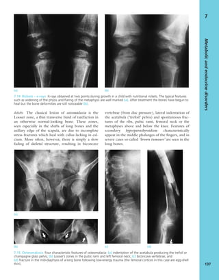 Metabolicandendocrinedisorders
137
7
7.14 Rickets – x-rays X-rays obtained at two points during growth in a child with nutritional rickets. The typical features
such as widening of the physis and ﬂaring of the metaphysis are well marked (a). After treatment the bones have begun to
heal but the bone deformities are still noticeable (b).
(a) (b)
Adults The classical lesion of osteomalacia is the
Looser zone, a thin transverse band of rarefaction in
an otherwise normal-looking bone. These zones,
seen especially in the shafts of long bones and the
axillary edge of the scapula, are due to incomplete
stress fractures which heal with callus lacking in cal-
cium. More often, however, there is simply a slow
fading of skeletal structure, resulting in biconcave
vertebrae (from disc pressure), lateral indentation of
the acetabula (‘trefoil’ pelvis) and spontaneous frac-
tures of the ribs, pubic rami, femoral neck or the
metaphyses above and below the knee. Features of
secondary hyperparathyroidism characteristically
appear in the middle phalanges of the ﬁngers, and in
severe cases so-called ‘brown tumours’ are seen in the
long bones.
(a)
(b) (c) (d)
7.15 Osteomalacia Four characteristic features of osteomalacia: (a) indentation of the acetabula producing the trefoil or
champagne glass pelvis; (b) Looser’s zones in the pubic rami and left femoral neck; (c) biconcave vertebrae; and
(d) fracture in the mid-diaphysis of a long bone following low-energy trauma (the femoral cortices in this case are egg-shell
thin).
 