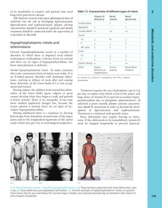of its metabolites is curative and patients may need
long-term parenteral calcium.
NB: Patients treated with supra-physiological doses of
calcitriol run the risk of developing hypercalcaemia,
hypercalciuria and nephrocalcinosis; plasma calcium
concentration should be measured regularly and ideally
treatment should be conducted under the supervision of
a specialist in this ﬁeld.
Hypophosphataemic rickets and
osteomalacia
Chronic hypophosphataemia occurs in a number of
disorders in which there is impaired renal tubular
reabsorption of phosphate. Calcium levels are normal
and there are no signs of hyperparathyroidism, but
bone mineralization is defective.
Familial hypophosphataemic rickets In many countries
this is the commonest form of rickets seen today. It is
an X-linked genetic disorder with dominant inheri-
tance, starting in infancy or soon after and causing
bony deformity of the lower limbs if it is not recog-
nized and treated.
During infancy the children look normal but defor-
mities of the lower limbs (genu valgum or genu
varum) develop when they begin to walk, and growth
is below normal. There is no myopathy. X-rays may
show marked epiphyseal changes but, because the
serum calcium is normal, there are no signs of sec-
ondary hyperparathyroidism.
During adulthood there is a tendency to develop
heterotopic bone formation around some of the larger
joints and in the longitudinal ligaments of the spinal
canal (which may give rise to neurological symptoms).
Treatment requires the use of phosphate (up to 3 g
per day, to replace that which is lost in the urine) and
large doses of vitamin D (to prevent secondary hyper-
parathyroidism due to phosphate administration). If
calcitriol is given instead, plasma calcium concentra-
tion should be monitored in order to forestall the devel-
opment of hypercalciuria and nephrocalcinosis.
Treatment is continued until growth ceases.
Bony deformities may require bracing or osteo-
tomy. If the child needs to be immobilized, vitamin D
must be stopped temporarily to prevent hypercal-
Metabolicandendocrinedisorders
139
7
(a) (b) (c)
7.16 Renal tubular rickets – familial hypophosphataemia (a) These brothers presented with knee deformities; their
x-rays (b) show defective juxta-epiphyseal calciﬁcation. (c) Another example of hypophosphataemic rickets; his growth
chart shows that he was well below the normal range in height, but improved dramatically on treatment with vitamin D
and inorganic phosphate.
Vitamin D
deﬁciency
Renal
tubular
Renal
glomerular
Family history – + –
Myopathy + – +
Growth defect ± ++ ++
Serum:
Ca ↓ N ↓
P ↓ ↓ ↑
Alk. phos. ↑ ↑ ↑
Urine:
Ca ↓ ↓ ↓
P ↓ ↑ ↓
Osteitis ﬁbrosa ± + ++
Other Dietary
deﬁciency or
malabsorption
Amino-
aciduria
Renal failure
Anaemia
N = normal; Ca = calcium; P = phosphorus; Alk. Phos. = alkaline
phosphatase.
Table 7.5 Characteristics of different types of rickets
 