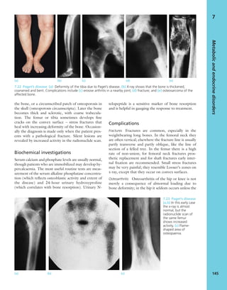 the bone, or a circumscribed patch of osteoporosis in
the skull (osteoporosis circumscripta). Later the bone
becomes thick and sclerotic, with coarse trabecula-
tion. The femur or tibia sometimes develops ﬁne
cracks on the convex surface – stress fractures that
heal with increasing deformity of the bone. Occasion-
ally the diagnosis is made only when the patient pres-
ents with a pathological fracture. Silent lesions are
revealed by increased activity in the radionuclide scan.
Biochemical investigations
Serum calcium and phosphate levels are usually normal,
though patients who are immobilized may develop hy-
percalcaemia. The most useful routine tests are meas-
urement of the serum alkaline phosphatase concentra-
tion (which reﬂects osteoblastic activity and extent of
the disease) and 24-hour urinary hydroxyproline
(which correlates with bone resorption). Urinary N-
telopeptide is a sensitive marker of bone resorption
and is helpful in gauging the response to treatment.
Complications
Fractures Fractures are common, especially in the
weightbearing long bones. In the femoral neck they
are often vertical; elsewhere the fracture line is usually
partly transverse and partly oblique, like the line of
section of a felled tree. In the femur there is a high
rate of non-union; for femoral neck fractures pros-
thetic replacement and for shaft fractures early inter-
nal ﬁxation are recommended. Small stress fractures
may be very painful; they resemble Looser’s zones on
x-ray, except that they occur on convex surfaces.
Osteoarthritis Osteoarthritis of the hip or knee is not
merely a consequence of abnormal loading due to
bone deformity; in the hip it seldom occurs unless the
Metabolicandendocrinedisorders
145
7
(a) (b) (c) (d) (e)
7.22 Paget’s disease (a) Deformity of the tibia due to Paget’s disease. (b) X-ray shows that the bone is thickened,
coarsened and bent. Complications include (c) erosive arthritis in a nearby joint; (d) fracture; and (e) osteosarcoma of the
affected bone.
(a) (b) (c)
7.23 Paget’s disease
(a,b) In this early case
the x-ray is almost
normal, but the
radionuclide scan of
the same femur
shows increased
activity. (c) Flame-
shaped area of
osteopaenia.
 
