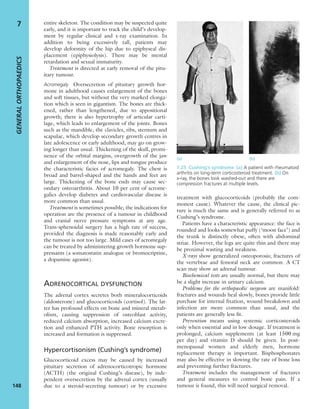 entire skeleton. The condition may be suspected quite
early, and it is important to track the child’s develop-
ment by regular clinical and x-ray examination. In
addition to being excessively tall, patients may
develop deformity of the hip due to epiphyseal dis-
placement (epiphysiolysis). There may be mental
retardation and sexual immaturity.
Treatment is directed at early removal of the pitu-
itary tumour.
Acromegaly Oversecretion of pituitary growth hor-
mone in adulthood causes enlargement of the bones
and soft tissues, but without the very marked elonga-
tion which is seen in gigantism. The bones are thick-
ened, rather than lengthened, due to appositional
growth; there is also hypertrophy of articular carti-
lage, which leads to enlargement of the joints. Bones
such as the mandible, the clavicles, ribs, sternum and
scapulae, which develop secondary growth centres in
late adolescence or early adulthood, may go on grow-
ing longer than usual. Thickening of the skull, promi-
nence of the orbital margins, overgrowth of the jaw
and enlargement of the nose, lips and tongue produce
the characteristic facies of acromegaly. The chest is
broad and barrel-shaped and the hands and feet are
large. Thickening of the bone ends may cause sec-
ondary osteoarthritis. About 10 per cent of acrome-
galics develop diabetes and cardiovascular disease is
more common than usual.
Treatment is sometimes possible; the indications for
operation are the presence of a tumour in childhood
and cranial nerve pressure symptoms at any age.
Trans-sphenoidal surgery has a high rate of success,
provided the diagnosis is made reasonably early and
the tumour is not too large. Mild cases of acromegaly
can be treated by administering growth hormone sup-
pressants (a somatostatin analogue or bromocriptine,
a dopamine agonist).
ADRENOCORTICAL DYSFUNCTION
The adrenal cortex secretes both mineralocorticoids
(aldosterone) and glucocorticoids (cortisol). The lat-
ter has profound effects on bone and mineral metab-
olism, causing suppression of osteoblast activity,
reduced calcium absorption, increased calcium excre-
tion and enhanced PTH activity. Bone resorption is
increased and formation is suppressed.
Hypercortisonism (Cushing’s syndrome)
Glucocorticoid excess may be caused by increased
pituitary secretion of adrenocorticotropic hormone
(ACTH) (the original Cushing’s disease), by inde-
pendent oversecretion by the adrenal cortex (usually
due to a steroid-secreting tumour) or by excessive
treatment with glucocorticoids (probably the com-
monest cause). Whatever the cause, the clinical pic-
ture is much the same and is generally referred to as
Cushing’s syndrome.
Patients have a characteristic appearance: the face is
rounded and looks somewhat puffy (‘moon face’) and
the trunk is distinctly obese, often with abdominal
striae. However, the legs are quite thin and there may
be proximal wasting and weakness.
X-rays show generalized osteoporosis; fractures of
the vertebrae and femoral neck are common. A CT
scan may show an adrenal tumour.
Biochemical tests are usually normal, but there may
be a slight increase in urinary calcium.
Problems for the orthopaedic surgeon are manifold:
fractures and wounds heal slowly, bones provide little
purchase for internal ﬁxation, wound breakdown and
infection are more common than usual, and the
patients are generally less ﬁt.
Prevention means using systemic corticosteroids
only when essential and in low dosage. If treatment is
prolonged, calcium supplements (at least 1500 mg
per day) and vitamin D should be given. In post-
menopausal women and elderly men, hormone
replacement therapy is important. Bisphosphonates
may also be effective in slowing the rate of bone loss
and preventing further fractures.
Treatment includes the management of fractures
and general measures to control bone pain. If a
tumour is found, this will need surgical removal.
GENERALORTHOPAEDICS
148
7
(a) (b)
7.25 Cushing’s syndrome (a) A patient with rheumatoid
arthritis on long-term corticosteroid treatment. (b) On
x-ray, the bones look washed-out and there are
compression fractures at multiple levels.
 