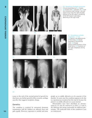 ceases at the end of the normal period of growth for
that bone; any further growth of the exostotic cartilage
cap after that suggests neoplastic change.
Genetics
The condition is acquired by autosomal dominant
transmission; half the children are affected, boys and
girls equally. However, expression is variable and some
people are so mildly affected as to be unaware of the
disorder. In some cases the condition appears to be due
to a spontaneous mutation but this may be because the
parent is so mildly affected as to seem normal.
Abnormalities have been identiﬁed on chromo-
somes 8, 11 and 19, referred to as EXT 1, 2 and 3,
the differing sites being responsible for different phe-
notypes. The molecular basis of this condition is not
yet understood.
GENERALORTHOPAEDICS
162
8 8.6 Hereditary multiple exostoses
Clinical presentation at (a) 3 years
(b) 6 years and (c) 28 years. In (c) note
the numerous small ‘bumps’, the one
large tumour near the right shoulder,
bowing of the left radius, shortening
of the left forearm and valgus
deformity of the right knee.
(a) (b) (c)
(a) (b) (c)
(d)
8.7 Hereditary multiple
exostoses – x-rays
(a) Typical x-ray appearances
of the knees. (b) Sessile
exostoses of the femoral
neck. (c) A large
pedunculated exostosis of the
distal femur. (d) Evolution of
the wide metaphysis during
growth.
 