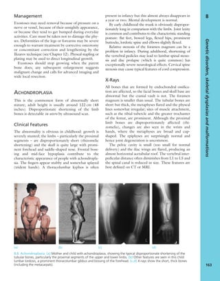 Management
Exostoses may need removal because of pressure on a
nerve or vessel, because of their unsightly appearance,
or because they tend to get bumped during everyday
activities. Care must be taken not to damage the phy-
ses. Deformities of the legs or forearms may be severe
enough to warrant treatment by corrective osteotomy
or concomitant correction and lengthening by the
Ilizarov technique (see Chapter 12). Physeal stapling or
plating may be used to direct longitudinal growth.
Exostoses should stop growing when the parent
bone does; any subsequent enlargement suggests
malignant change and calls for advanced imaging and
wide local resection.
ACHONDROPLASIA
This is the commonest form of abnormally short
stature; adult height is usually around 122 cm (48
inches). Disproportionate shortening of the limb
bones is detectable in utero by ultrasound scan.
Clinical Features
The abnormality is obvious in childhood: growth is
severely stunted; the limbs – particularly the proximal
segments – are disproportionately short (rhizomelic
shortening) and the skull is quite large with promi-
nent forehead and saddle-shaped nose. Frontal boss-
ing and mid-face hypoplasia contribute to the
characteristic appearance of people with achondropla-
sia. The ﬁngers appear stubby and somewhat splayed
(trident hands). A thoracolumbar kyphos is often
present in infancy but this almost always disappears in
a year or two. Mental development is normal.
By early childhood the trunk is obviously dispropor-
tionately long in comparison with the limbs. Joint laxity
is common and contributes to the characteristic standing
posture: ﬂat feet, bowed legs, ﬂexed hips, prominent
buttocks, lordotic spine and elbows slightly ﬂexed.
Relative stenosis of the foramen magnum can be a
problem in infancy. During adulthood, shortening of
the vertebral pedicles may lead to lumbar spinal steno-
sis and disc prolapse (which is quite common) has
exceptionally severe neurological effects. Cervical spine
stenosis may cause typical features of cord compression.
X-Rays
All bones that are formed by endochondral ossiﬁca-
tion are affected, so the facial bones and skull base are
abnormal but the cranial vault is not. The foramen
magnum is smaller than usual. The tubular bones are
short but thick, the metaphyses ﬂared and the physeal
lines somewhat irregular; sites of muscle attachment,
such as the tibial tubercle and the greater trochanter
of the femur, are prominent. Although the proximal
limb bones are disproportionately affected (rhi-
zomelia), changes are also seen in the wrists and
hands, where the metaphyses are broad and cup-
shaped. The epiphyses are surprisingly normal and
hence joint degeneration is uncommon.
The pelvic cavity is small (too small for normal
delivery) and the iliac wings are ﬂared, producing an
almost horizontal acetabular roof. The vertebral inter-
pedicular distance often diminishes from L1 to L5 and
the spinal canal is reduced in size. These features are
best deﬁned on CT or MRI.
Geneticdisorders,skeletaldysplasiasandmalformations
163
8
(a) (b) (c) (d)
8.8 Achondroplasia (a) Mother and child with achondroplasia, showing the typical disproportionate shortening of the
tubular bones, particularly the proximal segments of the upper and lower limbs. (b) Other features are seen in this child:
lumbar lordosis, a prominent thoracolumbar gibbus and bossing of the forehead. (c,d) X-rays show the short, thick bones
(including the metacarpals).
 