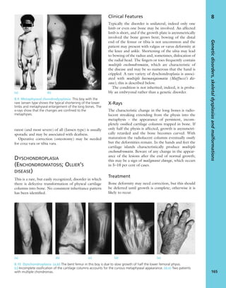 rarest (and most severe) of all (Jansen type) is usually
sporadic and may be associated with deafness.
Operative correction (osteotomy) may be needed
for coxa vara or tibia vara.
DYSCHONDROPLASIA
(ENCHONDROMATOSIS; OLLIER’S
DISEASE)
This is a rare, but easily recognized, disorder in which
there is defective transformation of physeal cartilage
columns into bone. No consistent inheritance pattern
has been identiﬁed.
Clinical Features
Typically the disorder is unilateral; indeed only one
limb or even one bone may be involved. An affected
limb is short, and if the growth plate is asymmetrically
involved the bone grows bent; bowing of the distal
end of the femur or tibia is not uncommon and the
patient may present with valgus or varus deformity at
the knee and ankle. Shortening of the ulna may lead
to bowing of the radius and, sometimes, dislocation of
the radial head. The ﬁngers or toes frequently contain
multiple enchondromata, which are characteristic of
the disease and may be so numerous that the hand is
crippled. A rare variety of dyschondroplasia is associ-
ated with multiple haemangiomata (Maffucci’s dis-
ease); this is described below.
The condition is not inherited; indeed, it is proba-
bly an embryonal rather than a genetic disorder.
X-Rays
The characteristic change in the long bones is radio-
lucent streaking extending from the physis into the
metaphysis – the appearance of persistent, incom-
pletely ossiﬁed cartilage columns trapped in bone. If
only half the physis is affected, growth is asymmetri-
cally retarded and the bone becomes curved. With
maturation the radiolucent columns eventually ossify
but the deformities remain. In the hands and feet the
cartilage islands characteristically produce multiple
enchondromata. Beware of any change in the appear-
ance of the lesions after the end of normal growth;
this may be a sign of malignant change, which occurs
in 5–10 per cent of cases.
Treatment
Bone deformity may need correction, but this should
be deferred until growth is complete; otherwise it is
likely to recur.
Geneticdisorders,skeletaldysplasiasandmalformations
165
8
8.9 Metaphyseal chondrodysplasia This boy with the
rare Jansen type shows the typical shortening of the lower
limbs and metaphyseal enlargement of the long bones. The
x-rays show that the changes are conﬁned to the
metaphyses.
(a) (b)
(a) (b) (c) (d) (e)
8.10 Dyschondroplasia (a,b) The bent femur in this boy is due to slow growth of half the lower femoral physis.
(c) Incomplete ossiﬁcation of the cartilage columns accounts for the curious metaphyseal appearance. (d,e) Two patients
with multiple chondromas.
 