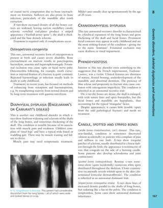 or cranial nerve compression due to bone encroach-
ment on foramina. Sufferers are also prone to bone
infection, particularly of the mandible after tooth
extraction.
X-rays show increased density of all the bones: cor-
tices are widened, leaving narrow medullary canals;
sclerotic vertebral end-plates produce a striped
appearance (‘football-jersey spine’); the skull is thick-
ened and the base densely sclerotic.
Treatment is required only if complications occur.
Osteopetrosis congenita
This rare, autosomal recessive form of osteopetrosis is
present at birth and causes severe disability. Bone
encroachment on marrow results in pancytopenia,
haemolysis, anaemia and hepatosplenomegaly. Foram-
inal occlusion may cause optic or facial nerve palsy.
Osteomyelitis following, for example, tooth extrac-
tion or internal ﬁxation of a fracture is quite common.
Repeated haemorrhage or infection usually leads to
death in early childhood.
Treatment, in recent years, has focused on methods
of enhancing bone resorption and haematopoeisis,
e.g. by transplanting marrow from normal donors and
by long-term treatment with gamma-interferon.
DIAPHYSEAL DYSPLASIA (ENGELMANN’S
OR CAMURATI’S DISEASE)
This is another rare childhood disorder in which x-
rays show fusiform widening and sclerosis of the shafts
of the long bones, and sometimes thickening of the
skull. The condition is notable because of its associa-
tion with muscle pain and weakness. Children com-
plain of ‘tired legs’ and have a typical wide-based or
waddling gait. There may be muscle wasting and fail-
ure to thrive.
Muscle pain may need symptomatic treatment.
Milder cases usually clear up spontaneously by the age
of 25 years.
CRANIODIAPHYSEAL DYSPLASIA
This rare autosomal recessive disorder is characterized
by cylindrical expansion of the long bones and gross
thickening of the skull and facial bones. Prominent
facial contours may appear in early childhood and are
the most striking feature of the condition – giving rise
to the name ‘leontiasis’. Foraminal occlusion may
cause deafness or visual impairment.
PYKNODYSOSTOSIS
Interest in this rare disorder owes something to the
suggestion that the French impressionist, Toulouse-
Lautrec, was a victim. Clinical features are shortness
of stature, frontal bossing, underdevelopment of the
mandible and abnormal dentition. The presence of
blue sclerae and propensity to fracture may cause con-
fusion with osteogenesis imperfecta. The condition is
inherited as an autosomal recessive trait.
On x-ray the bones are dense; the skull is enlarged,
with wide suture lines and open fontanelles, but the
facial bones and mandible are hypoplastic, thus
accounting for the typical ‘triangular’ facies.
Despite appearances, it causes little trouble (apart
from the odd pathological fracture) and needs no
treatment.
CANDLE, SPOTTED AND STRIPED BONES
Candle bones (melorheostosis, Leri’s disease) This rare,
non-familial, condition is sometimes discovered
(almost accidentally) in patients who complain of pain
and stiffness in one limb. X-rays show irregular
patches of sclerosis, usually distributed in a linear fash-
ion through the limb; the appearance is reminiscent of
wax that congeals on the side of a burning candle.
Some patients also develop scleroderma and joint
contractures.
Spotted bones (osteopoikilosis) Routine x-rays some-
times show (quite incidentally) numerous white spots
distributed throughout the skeleton. Closer examina-
tion occasionally reveals whitish spots in the skin (dis-
seminated lenticular dermatoﬁbrosis). The condition
is inherited as an autosomal dominant trait.
Striped bones (osteopathia striata) X-rays show lines of
increased density parallel to the shafts of long bones,
but radiating like a fan in the pelvis. The condition is
symptomless. Some cases show autosomal dominant
inheritance.
Geneticdisorders,skeletaldysplasiasandmalformations
167
8
8.12 Engelmann’s disease This patient had considerable
discomfort from her long bones – all of which were wide
and looked dense on x-ray.
 