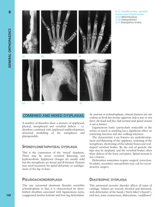 COMBINED AND MIXED DYSPLASIAS
A number of disorders show a mixture of epiphyseal,
physeal, metaphyseal and vertebral defects – i.e.
dwarﬁsm combined with epiphyseal maldevelopment,
abnormal modelling of the metaphyses and
platyspondyly.
SPONDYLOMETAPHYSEAL DYSPLASIA
This is the commonest of the ‘mixed’ dysplasias.
There may be severe vertebral ﬂattening and
kyphoscoliosis. Epiphyseal changes are usually mild
but the metaphyses are broad and ill-formed. Patients
may need treatment for spinal deformity or malalign-
ment of the hip or knee.
PSEUDOACHONDROPLASIA
This rare autosomal dominant disorder resembles
achondroplasia in that it is characterized by short-
limbed dwarﬁsm associated with ligamentous laxity,
exaggerated lumbar lordosis and bow-leg deformities.
In contrast to achondroplasia, clinical features are not
evident at birth but become apparent only a year or two
later; the head and face look normal and spinal stenosis
is not a feature.
Ligamentous laxity (particularly noticeable in the
wrists) as much as anything has a signiﬁcant effect on
restricting function and also walking tolerance.
The characteristic x-ray features are underdevelop-
ment and ﬂattening of the epiphyses, widening of the
metaphyses, shortening of the tubular bones and oval-
shaped vertebral bodies. By the end of growth, the
hips may be dysplastic and the vertebral bodies often
show defects of the bony end-plates. Spinal stenosis is
not a feature.
Deformities sometimes require surgical correction.
In adults, secondary osteoarthritis may call for recon-
structive surgery.
DIASTROPHIC DYSPLASIA
This autosomal recessive disorder affects all types of
cartilage. Infants are severely dwarfed and distorted,
with deformities of the hands (‘hitch-hiker’s thumb’),
club feet, joint contractures, dislocations, ‘cauliﬂower’
GENERALORTHOPAEDICS
168
8
(a) (b) (c)
(d) (e) (f)
8.13 Candle bones, spotted
bones and striped bones
(a,b) Melorheostosis
(c,d) Osteopoikilosis
(e,f) Osteopathia striatia.
 