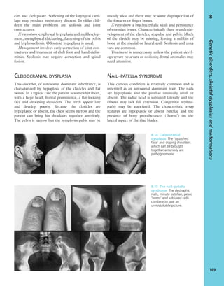 ears and cleft palate. Softening of the laryngeal carti-
lage may produce respiratory distress. In older chil-
dren the main problems are scoliosis and joint
contractures.
X-rays show epiphyseal hypoplasia and maldevelop-
ment, metaphyseal thickening, ﬂattening of the pelvis
and kyphoscoliosis. Odontoid hypoplasia is usual.
Management involves early correction of joint con-
tractures and treatment of club foot and hand defor-
mities. Scoliosis may require correction and spinal
fusion.
CLEIDOCRANIAL DYSPLASIA
This disorder, of autosomal dominant inheritance, is
characterized by hypoplasia of the clavicles and ﬂat
bones. In a typical case the patient is somewhat short,
with a large head, frontal prominence, a ﬂat-looking
face and drooping shoulders. The teeth appear late
and develop poorly. Because the clavicles are
hypoplastic or absent, the chest seems narrow and the
patient can bring his shoulders together anteriorly.
The pelvis is narrow but the symphysis pubis may be
unduly wide and there may be some disproportion of
the forearm or ﬁnger bones.
X-rays show a brachycephalic skull and persistence
of wormian bones. Characteristically there is underde-
velopment of the clavicles, scapulae and pelvis. Much
of the clavicle may be missing, leaving a nubbin of
bone at the medial or lateral end. Scoliosis and coxa
vara are common.
Treatment is unnecessary unless the patient devel-
ops severe coxa vara or scoliosis; dental anomalies may
need attention.
NAIL–PATELLA SYNDROME
This curious condition is relatively common and is
inherited as an autosomal dominant trait. The nails
are hypoplastic and the patellae unusually small or
absent. The radial head is subluxed laterally and the
elbows may lack full extension. Congenital nephro-
pathy may be associated. The characteristic x-ray
features are hypoplastic or absent patellae and the
presence of bony protuberances (‘horns’) on the
lateral aspect of the iliac blades.
Geneticdisorders,skeletaldysplasiasandmalformations
169
8
8.14 Cleidocranial
dysplasia The ‘squashed
face’ and sloping shoulders
which can be brought
together anteriorly are
pathognomonic.
8.15 The nail–patella
syndrome The dystrophic
nails, minute patellae, pelvic
‘horns’ and subluxed radii
combine to give an
unmistakable picture.
 