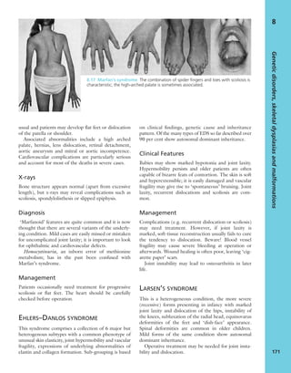 usual and patients may develop ﬂat feet or dislocation
of the patella or shoulder.
Associated abnormalities include a high arched
palate, hernias, lens dislocation, retinal detachment,
aortic aneurysm and mitral or aortic incompetence.
Cardiovascular complications are particularly serious
and account for most of the deaths in severe cases.
X-rays
Bone structure appears normal (apart from excessive
length), but x-rays may reveal complications such as
scoliosis, spondylolisthesis or slipped epiphysis.
Diagnosis
‘Marfanoid’ features are quite common and it is now
thought that there are several variants of the underly-
ing condition. Mild cases are easily missed or mistaken
for uncomplicated joint laxity; it is important to look
for ophthalmic and cardiovascular defects.
Homocystinuria, an inborn error of methionine
metabolism; has in the past been confused with
Marfan’s syndrome.
Management
Patients occasionally need treatment for progressive
scoliosis or ﬂat feet. The heart should be carefully
checked before operation.
EHLERS–DANLOS SYNDROME
This syndrome comprises a collection of 6 major but
heterogenous subtypes with a common phenotype of
unusual skin elasticity, joint hypermobility and vascular
fragility, expressions of underlying abnormalities of
elastin and collagen formation. Sub-grouping is based
on clinical ﬁndings, genetic cause and inheritance
pattern. Of the many types of EDS so far described over
90 per cent show autosomal dominant inheritance.
Clinical Features
Babies may show marked hypotonia and joint laxity.
Hypermobility persists and older patients are often
capable of bizarre feats of contortion. The skin is soft
and hyperextensible; it is easily damaged and vascular
fragility may give rise to ‘spontaneous’ bruising. Joint
laxity, recurrent dislocations and scoliosis are com-
mon.
Management
Complications (e.g. recurrent dislocation or scoliosis)
may need treatment. However, if joint laxity is
marked, soft-tissue reconstruction usually fails to cure
the tendency to dislocation. Beware! Blood vessel
fragility may cause severe bleeding at operation or
afterwards. Wound healing is often poor, leaving ‘cig-
arette paper’ scars.
Joint instability may lead to osteoarthritis in later
life.
LARSEN’S SYNDROME
This is a heterogeneous condition, the more severe
(recessive) forms presenting in infancy with marked
joint laxity and dislocation of the hips, instability of
the knees, subluxation of the radial head, equinovarus
deformities of the feet and ‘dish-face’ appearance.
Spinal deformities are common in older children.
Mild forms of the same condition show autosomal
dominant inheritance.
Operative treatment may be needed for joint insta-
bility and dislocation.
Geneticdisorders,skeletaldysplasiasandmalformations
171
8
8.17 Marfan’s syndrome The combination of spider ﬁngers and toes with scoliosis is
characteristic; the high-arched palate is sometimes associated.
 