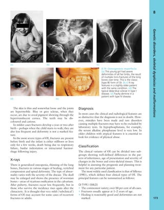 The skin is thin and somewhat loose and the joints
are hypermobile. Blue or grey sclerae, when they
occur, are due to uveal pigment showing through the
hypertranslucent cornea. The teeth may be dis-
coloured and carious.
In milder cases fractures develop a year or two after
birth – perhaps when the child starts to walk; they are
also less frequent and deformity is not a marked fea-
ture.
In the most severe types of OI, fractures are present
before birth and the infant is either stillborn or lives
only for a few weeks, death being due to respiratory
failure, basilar indentation or intracranial haemor-
rhage following injury.
X-rays
There is generalized osteopenia, thinning of the long
bones, fractures in various stages of healing, vertebral
compression and spinal deformity. The type of abnor-
mality varies with the severity of the disease. The skull
may be enlarged and shows the presence of wormian
bones – areas of vicarious ossiﬁcation in the calvarium.
After puberty, fractures occur less frequently, but in
those who survive the incidence rises again after the
climacteric. It is thought that very mild (‘subclinical’)
forms of OI may account for some cases of recurrent
fractures in adults.
Diagnosis
In most cases the clinical and radiological features are
so distinctive that the diagnosis is not in doubt. How-
ever, mistakes have been made and rare disorders
causing multiple fractures may have to be excluded by
laboratory tests. In hypophosphatasia, for example,
the serum alkaline phosphatase level is very low. In
older children with atypical features it is essential to
look for evidence of physical abuse.
Classification
The clinical variants of OI can be divided into sub-
groups showing well-deﬁned differences in the pat-
tern of inheritance, age of presentation and severity of
changes in the bones and extra-skeletal tissues. This is
helpful in assessing the prognosis and planning treat-
ment for any particular patient.
The most widely used classiﬁcation is that of Sillence
(1981), which deﬁnes four clinical types of OI. The
principal features can be summarized as follows:
OI TYPE I (MILD)
• The commonest variety; over 50 per cent of all cases.
• Fractures usually appear at 1–2 years of age.
• Healing is reasonably good and deformities are not
marked.
Geneticdisorders,skeletaldysplasiasandmalformations
173
8
(a) (b) (c)
(d) (e)
8.19 Osteogenesis imperfecta
(a) This young girl had severe
deformities of all her limbs, the result
of multiple mini-fractures of the long
bones over time. This is the classic
(type III) form of OI. (b,c) X-ray
features in a slightly older patient
with the same condition. (d) The
typical deep blue sclerae in type I
disease. (e) Faulty dentine in a
patient with type IV disease.
 