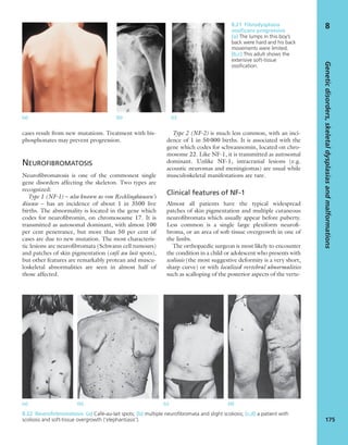 cases result from new mutations. Treatment with bis-
phosphonates may prevent progression.
NEUROFIBROMATOSIS
Neuroﬁbromatosis is one of the commonest single
gene disorders affecting the skeleton. Two types are
recognized:
Type 1 (NF-1) – also known as von Recklinghausen’s
disease – has an incidence of about 1 in 3500 live
births. The abnormality is located in the gene which
codes for neuroﬁbromin, on chromososme 17. It is
transmitted as autosomal dominant, with almost 100
per cent penetrance, but more than 50 per cent of
cases are due to new mutation. The most characteris-
tic lesions are neuroﬁbromata (Schwann cell tumours)
and patches of skin pigmentation (café au lait spots),
but other features are remarkably protean and muscu-
loskeletal abnormalities are seen in almost half of
those affected.
Type 2 (NF-2) is much less common, with an inci-
dence of 1 in 50000 births. It is associated with the
gene which codes for schwannomin, located on chro-
mosome 22. Like NF-1, it is transmitted as autosomal
dominant. Unlike NF-1, intracranial lesions (e.g.
acoustic neuromas and meningiomas) are usual while
musculoskeletal manifestations are rare.
Clinical features of NF-1
Almost all patients have the typical widespread
patches of skin pigmentation and multiple cutaneous
neuroﬁbromata which usually appear before puberty.
Less common is a single large plexiform neuroﬁ-
broma, or an area of soft-tissue overgrowth in one of
the limbs.
The orthopaedic surgeon is most likely to encounter
the condition in a child or adolescent who presents with
scoliosis (the most suggestive deformity is a very short,
sharp curve) or with localized vertebral abnormalities
such as scalloping of the posterior aspects of the verte-
Geneticdisorders,skeletaldysplasiasandmalformations
175
88.21 Fibrodysplasia
ossiﬁcans progressive
(a) The lumps in this boy’s
back were hard and his back
movements were limited.
(b,c) This adult shows the
extensive soft-tissue
ossiﬁcation.
(a) (b) (c)
8.22 Neuroﬁrbromatosis (a) Café-au-lait spots; (b) multiple neuroﬁbromata and slight scoliosis; (c,d) a patient with
scoliosis and soft-tissue overgrowth (‘elephantiasis’).
(a) (b) (c) (d)
 